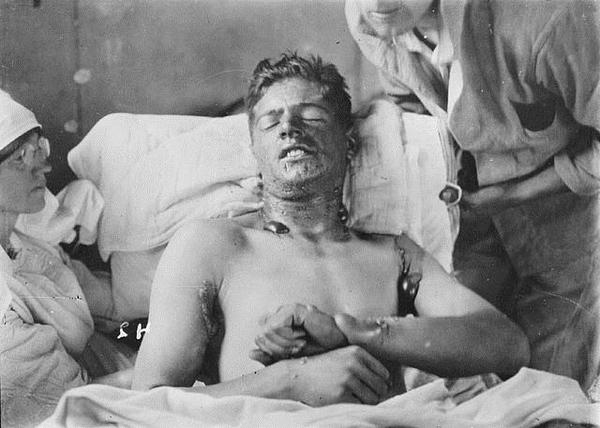 Канадский солдат после поражения ипритом. 1918 г.