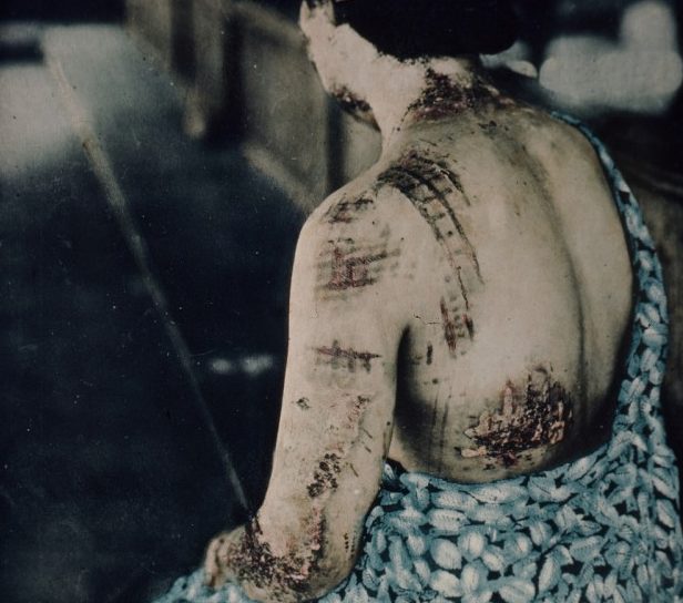 Ожоги тяжелой степени. На коже остались узоры от кимоно. Август, 1945 г.