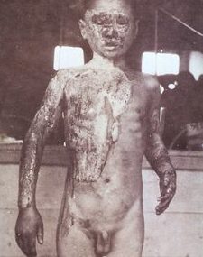 Японский мальчик с ожогами после взрыва. Август 1945 г.