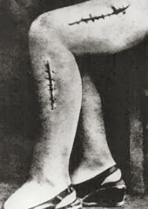Свежие швы после проведения операций по трансплантации нервных, мышечных и костных тканей, тайно сфотографированные членами польского Сопротивления.